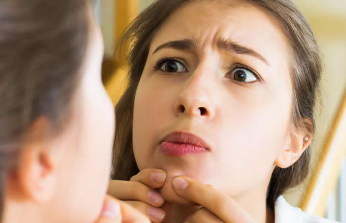 5 Ways to Vanish Forehead Acne